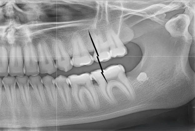 Discover how night guards help prevent cracked teeth and protect your smile from grinding damage. Learn safe prevention tips with NewSmile.