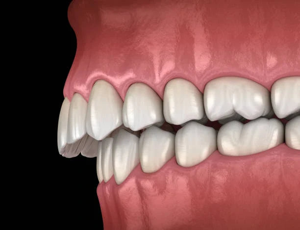 Can Retainers Straighten Teeth? | Alternatives To Braces - NewSmile UK